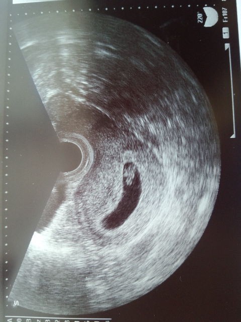 エコー画像 胎嚢の形で流産の可能性がわかる 2人目不妊治療中 流産 親と同居生活