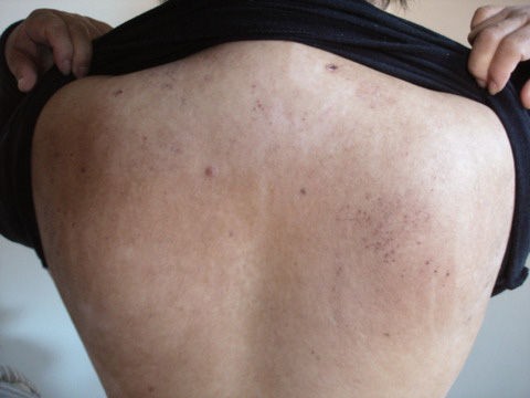 腕の内側にブツブツ アトピー悪化からの皮膚再生をがんばるブログ