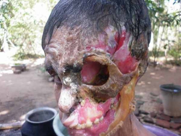 グロ注意 熱帯感染症によって顔の半分が骸骨の様になった女性 Un Idiot