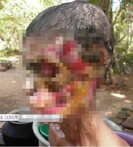 グロ注意 熱帯感染症によって顔の半分が骸骨の様になった女性 Un Idiot