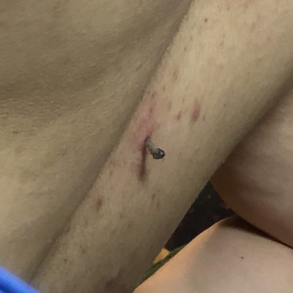 背中のでけえ角栓とったｗｗｗｗｗｗｗｗ 芸速 2ch芸能まとめニュース