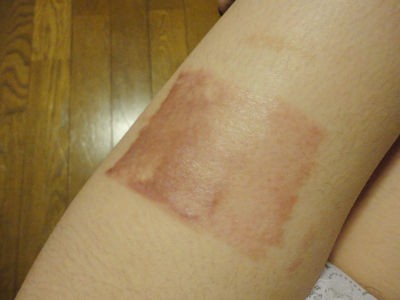 手術からもうすぐ8ヶ月 アットノンはじめました タトゥー 入れ墨除去経過ブログ