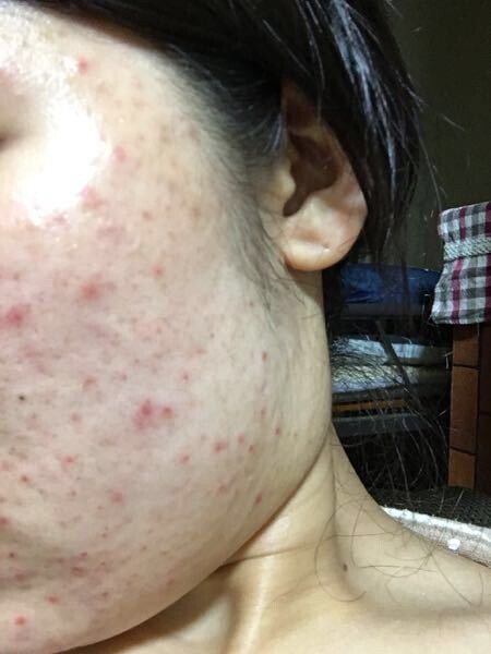 なんj 成人してもニキビ治らない部 それな速報