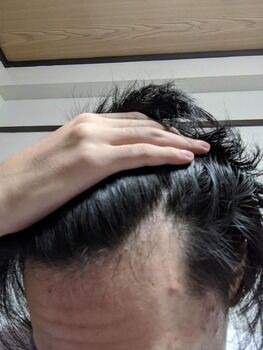 悲報 ワイ大学生 M字ハゲのごまかしが効かなくなる 剃り込みすげえ 画像あり てきとーまとめ