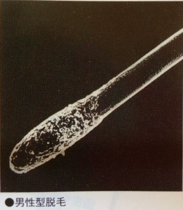 あなたの抜け毛の毛根はどの形 Thbプラセントスカルプローション Thbshopのblog