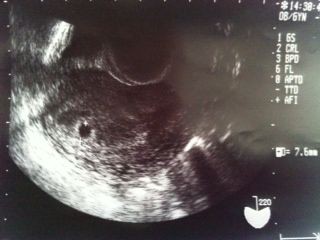 妊娠初期中 稽留流産 あったかいハート