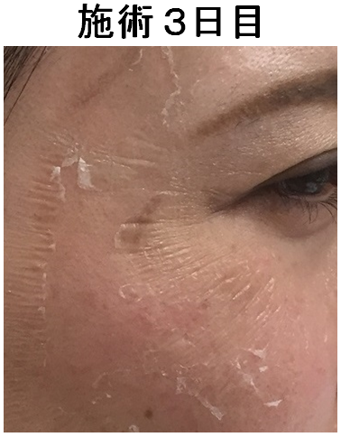 Easytcaﾋﾟｰﾘﾝｸﾞのダウンタイムはこんな感じです トキコレ