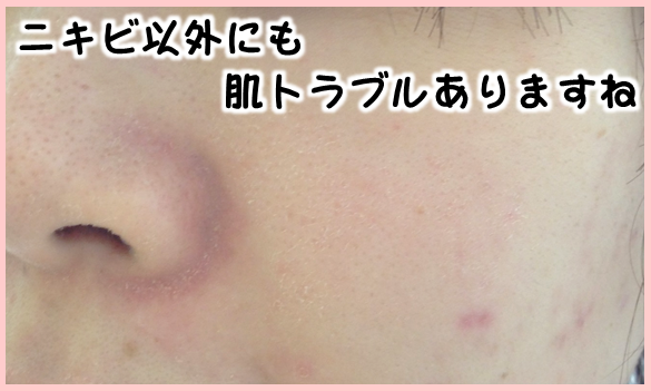 ケミカルピーリング体験記 ニキビ治療始めました 施術直後の写真見て下さ い トキコレ