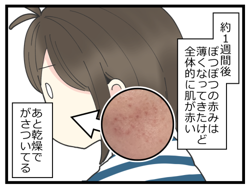 ニキビ治療始めました おもいだす Powered By ライブドアブログ