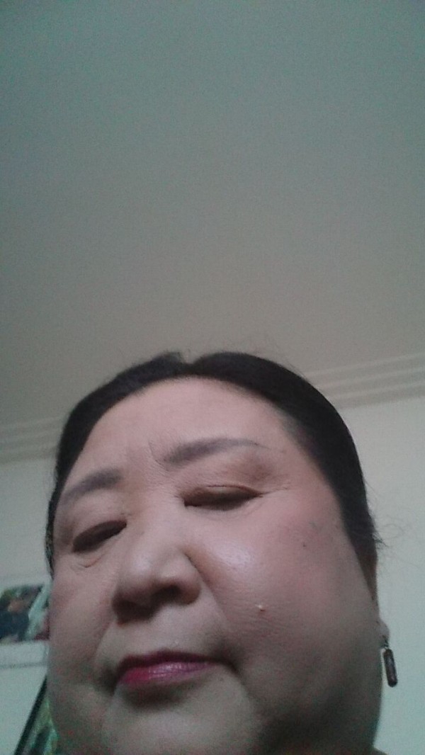 腫れた顔 New天使の羽 腫れた顔 New天使の羽