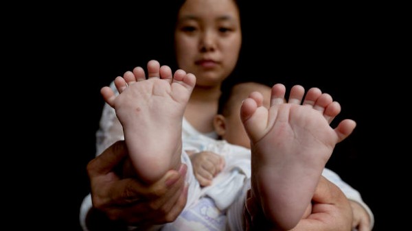 中国 手と足の指が全部合わせて31本 多指症 の赤ちゃんが話題に 海外 トーイチャンネット 時事ネタ