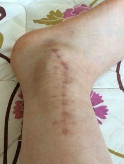 抜釘手術８日前 準備と今の足の傷の様子 Tapitapiの足骨折日記