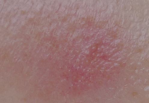 シミがほぼ消えた トレチノイン ハイドロキノンいちご鼻使用体験記