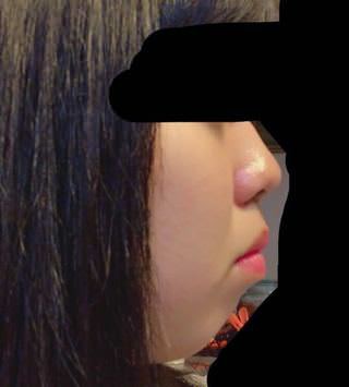 画像 アデノイドの横顔キモすぎｗｗｗ ていへん