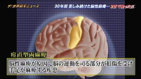 痙直型両麻痺とドーパ反応性ジストニア テレビっ子ひなのブログ