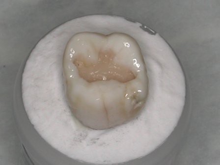 ダイレクトボンディングのお稽古 臼歯咬合面の作りかた Moriura Dental Clinic 予防歯科ブログ