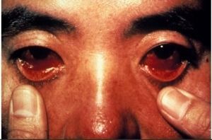 閲覧注意 エボラ出血熱の怖さがわかる画像まとめ ぴよ速 E