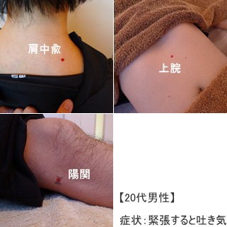 このツボ 吐き気と肩こりに陽関 足 鍼灸師のツボ日記