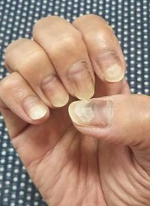 がん日記 21 3 7 抗がん剤その後 ゆみさんのぽろぽろ