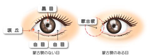 蒙古ひだとは 自力で二重まぶたを目指す