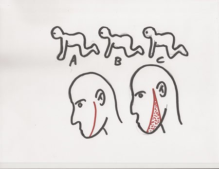 人間ムカデの作り方 The Human Centipede のスケッチ Zombie手帖ブログ